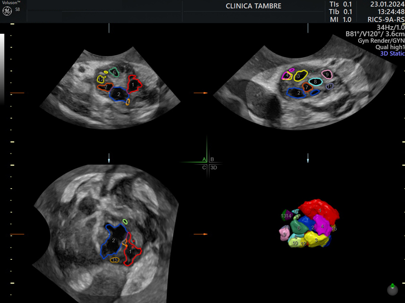 ECO_2 Antral Follikel Ultraschall 3D