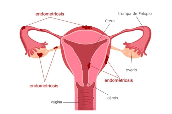 endometrosis explicativo