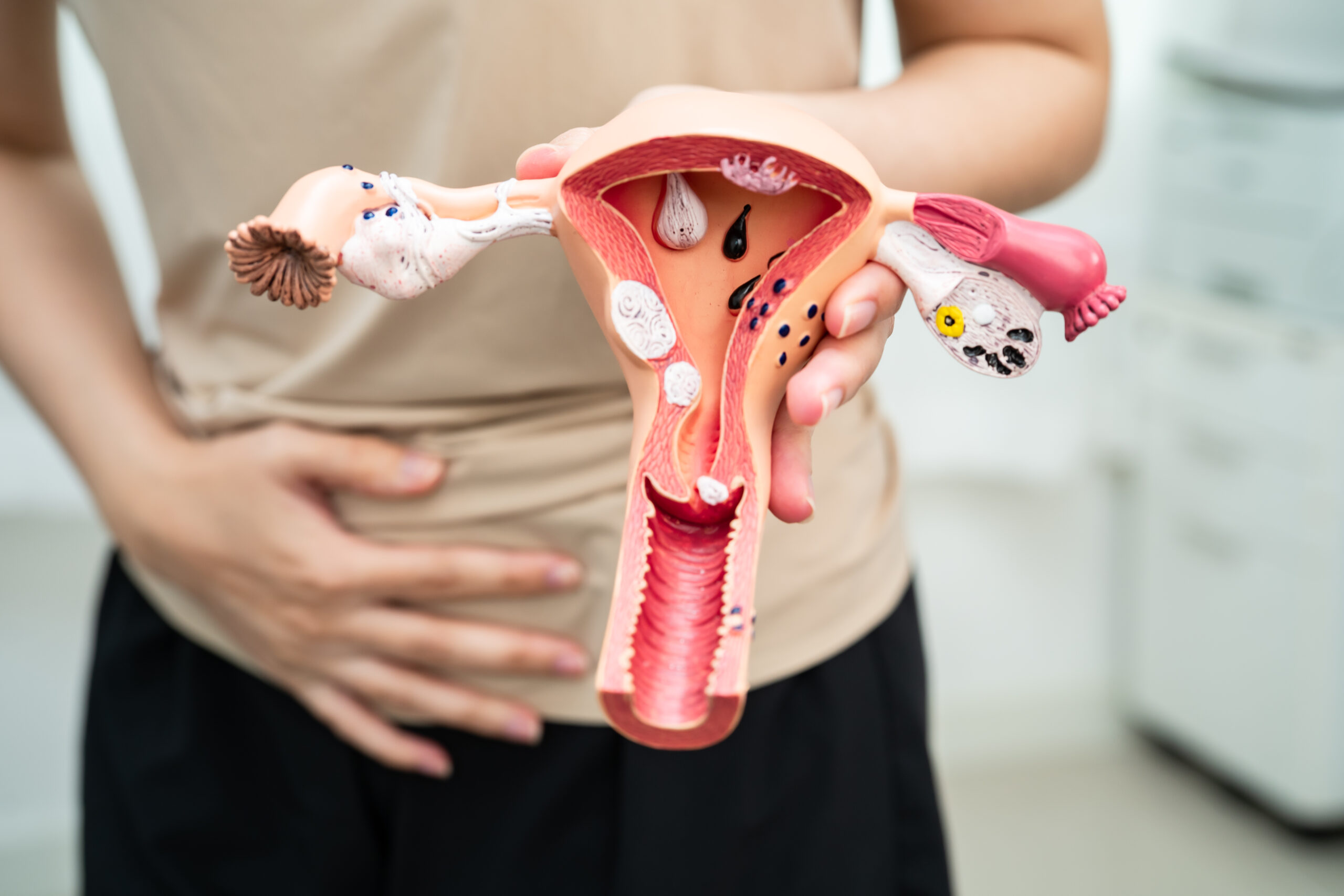 Endometriosis and fertility, why do you need personalised treatment?